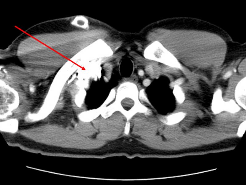 IV Placement to Increase or Decrease Diagnostic Yield of CT Angiography in Penetrating Neck Trauma