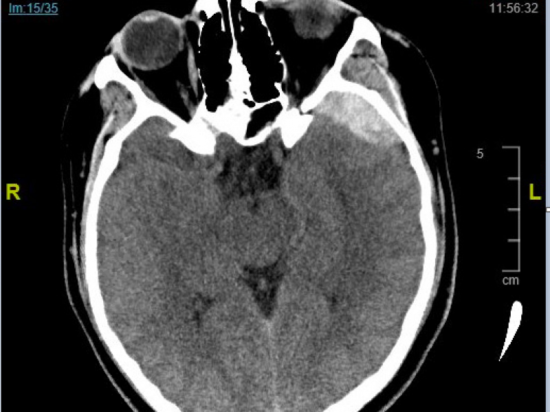 Critical Cases - Epidural Hematoma!