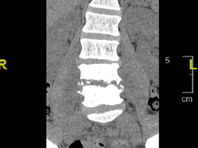 Critical Cases - Spine Emergency!