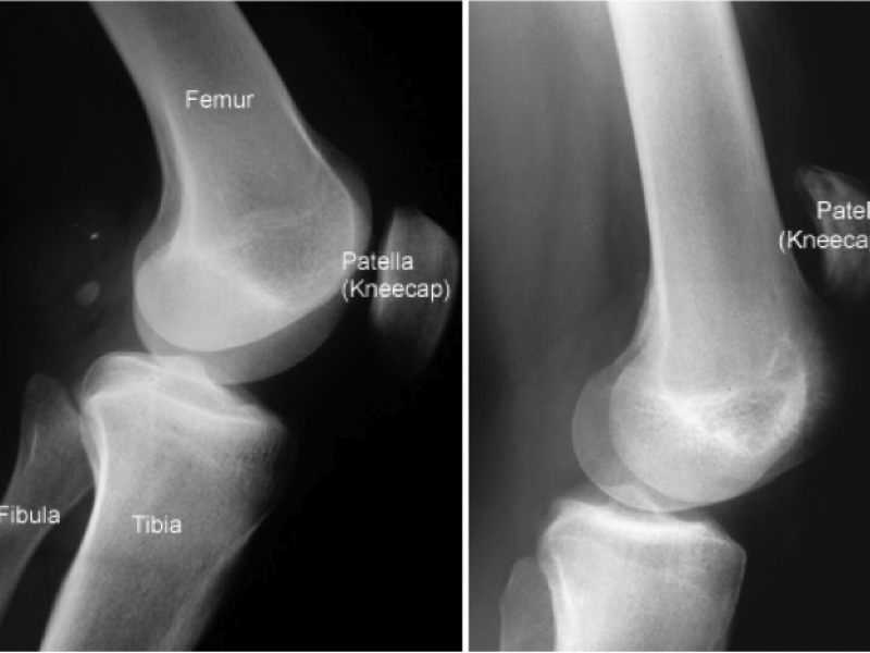 Orthopedic Injuries Around the NFL: Derek Newton's Bilateral Patella Tendons Rupture