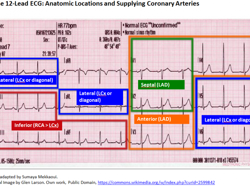 Back to Basics:  ECG Findings in Acute Myocardial Infarction: Identifying the Culprit Vessel