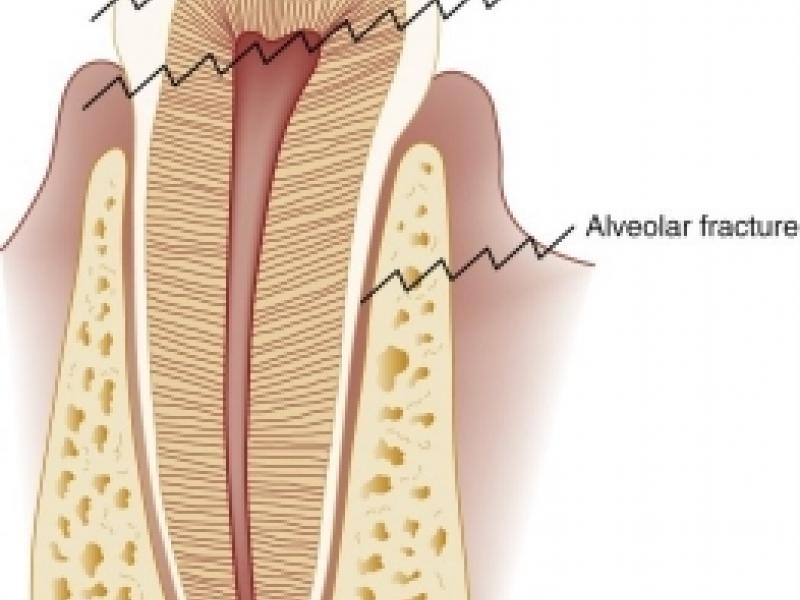 Back to Basics: Dental Fractures