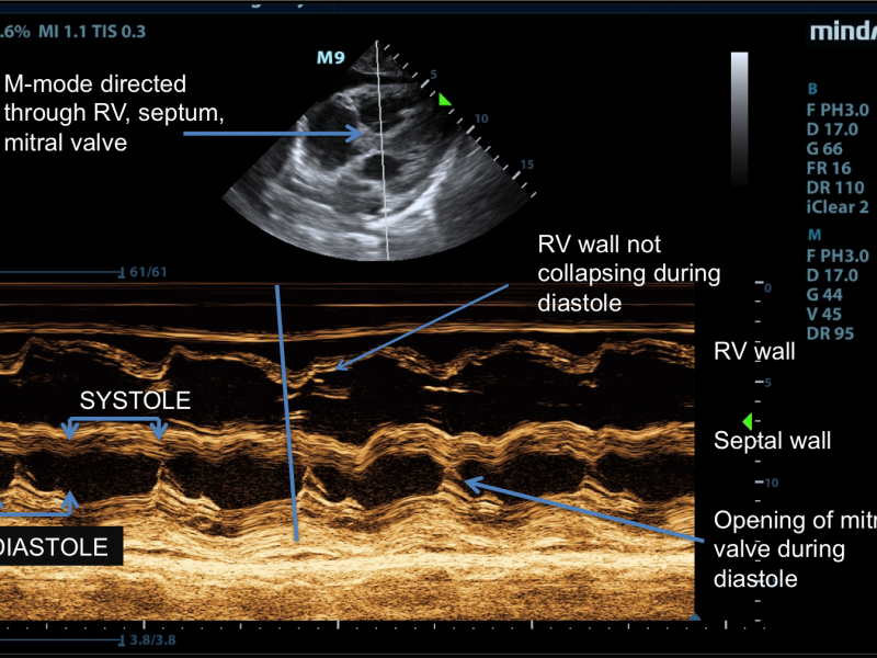 Cardiac Tamponade