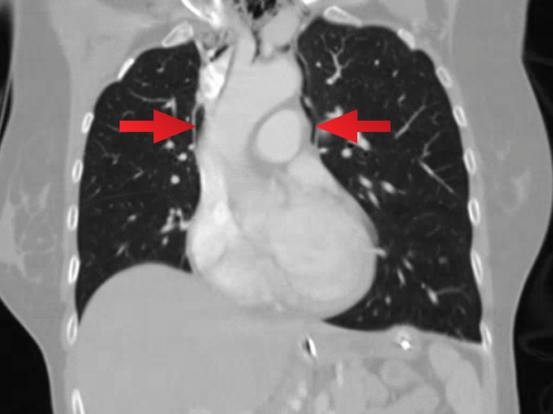 Pneumomediastinum: Critical Care Consult vs. Observation