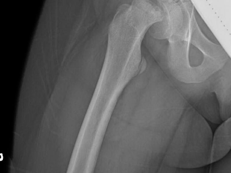 Back to Basics: Slipped Capital Femoral Epiphysis