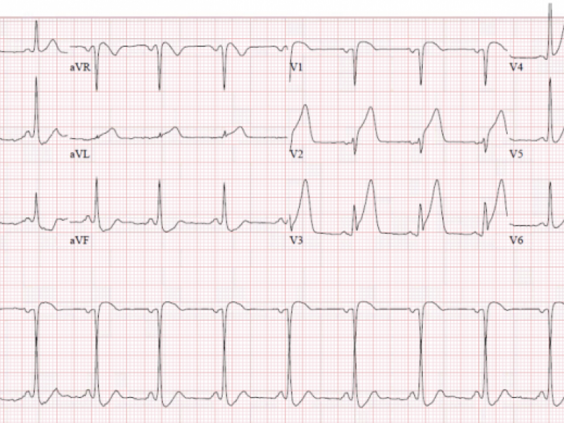 Interesting case of chest pain