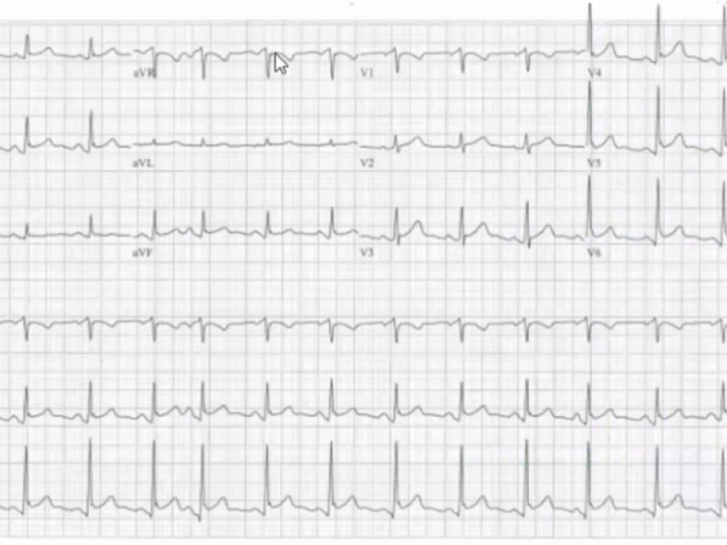 #EMConf: ECG