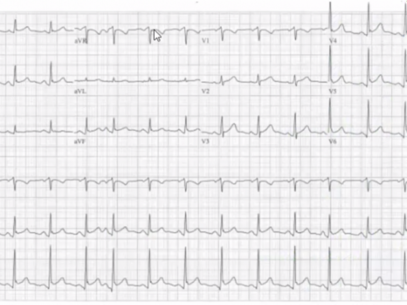 #EMConf: ECG 