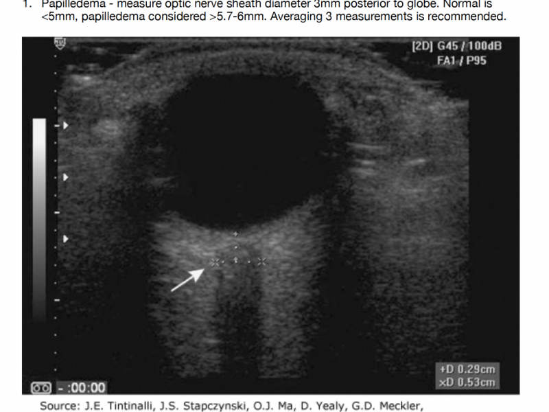 Back to Basics: Ocular Ultrasound Part 2