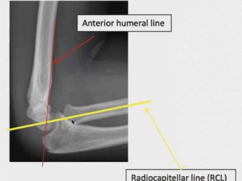 #EMConf: Pediatric Elbow