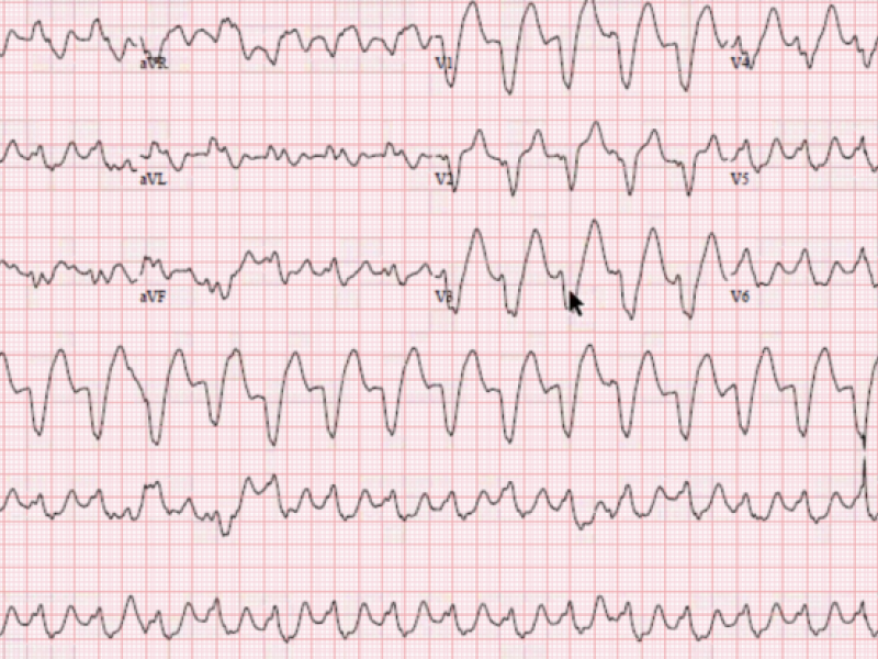 #EMConf: ECG