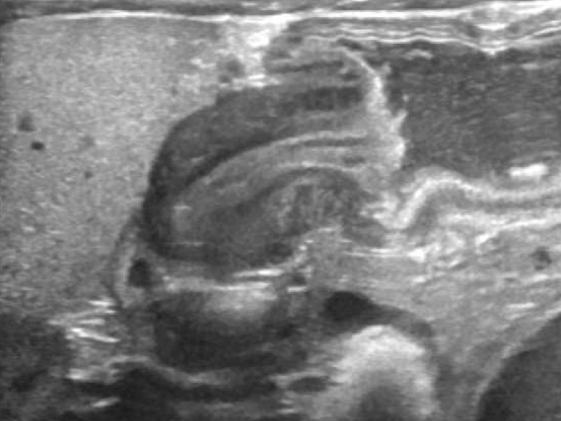 Imaging Case: Six Week-Old Infant with Projectile Vomiting