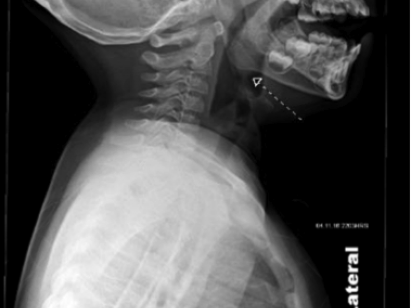 Imaging Case Answer: Foreign Body