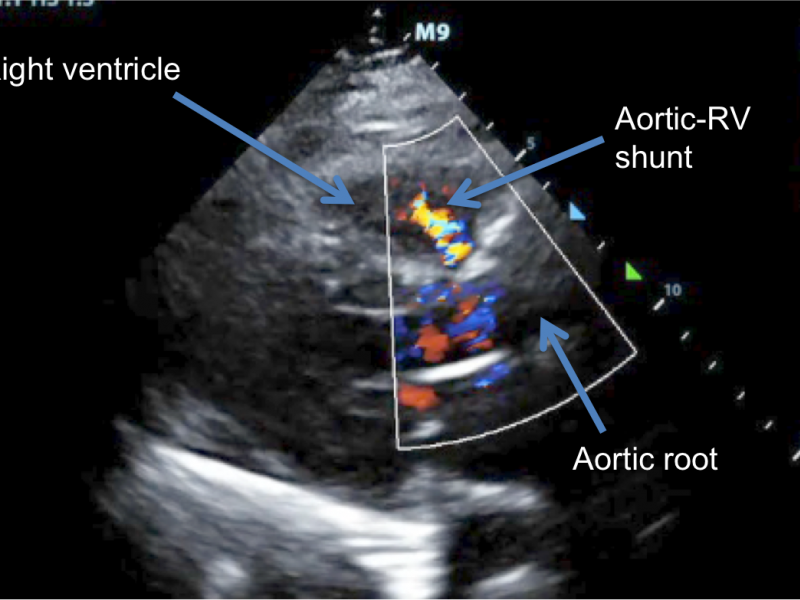 Doppler Echocardiography: Unique post-TAVR Jet