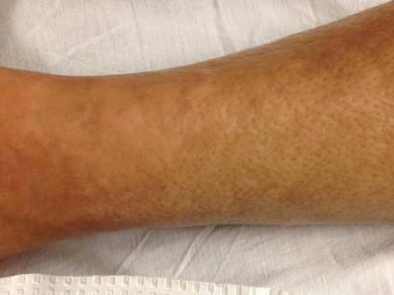 Critical cases - Eosinophilic fasciitis!