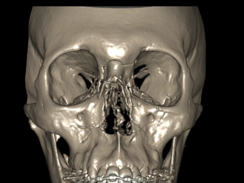 Board Review: Facial Trauma