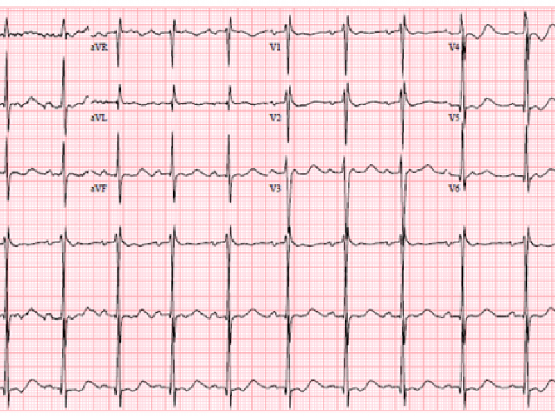 Critical Cases - Thyrotoxic Periodic Paralysis