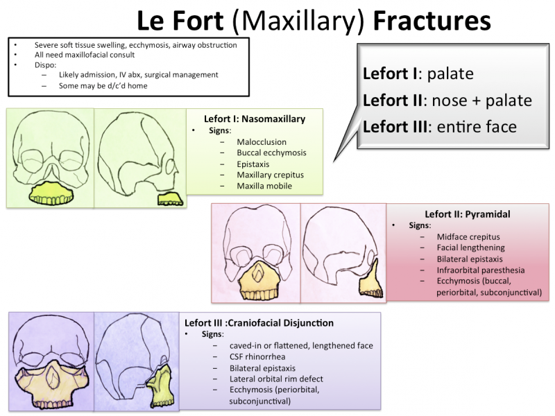 Back to Basics:  Le Fort Fractures