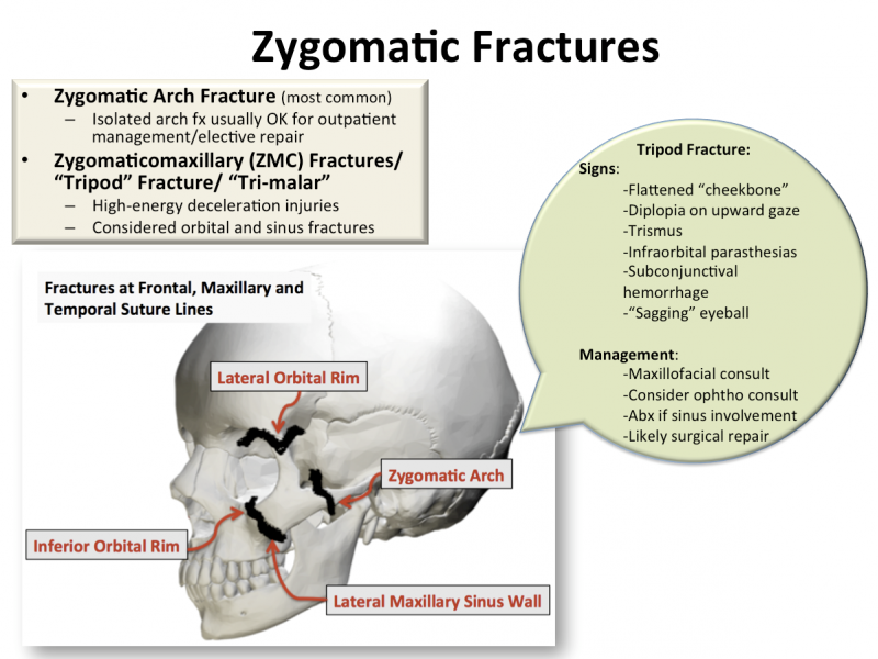 Back to Basics:  Zygomatic Fractures